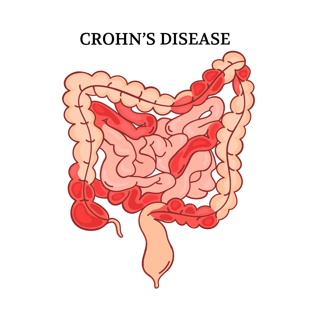 CROHN DISEASE VIDEO Intestinal Medicine Anatomy Animation Inspire Uplift