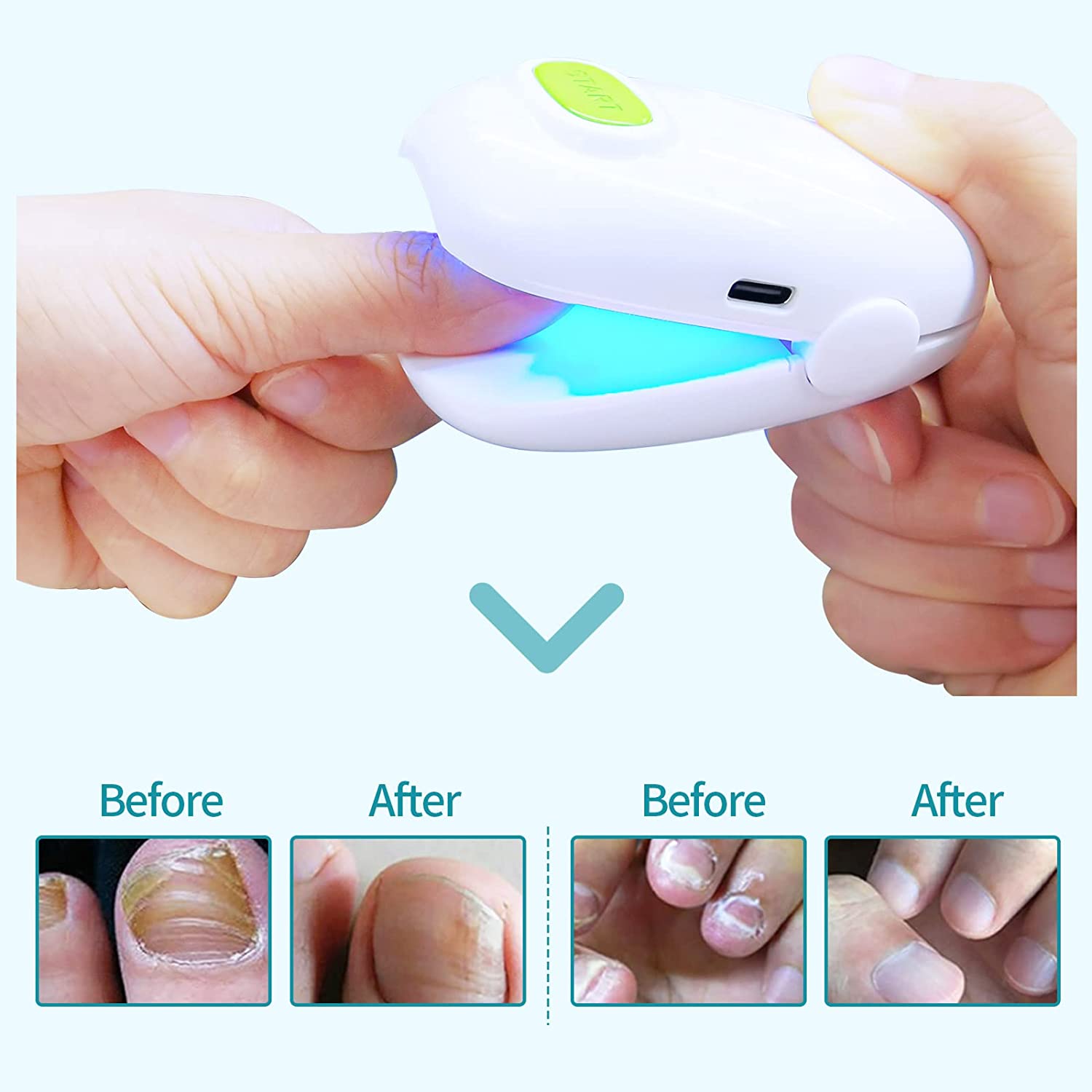 Laser Nail Fungus treatment device Cleaning LaserDevice for Inspire